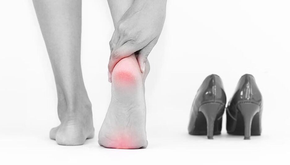The reason for the appearance of varicose veins is uncomfortable shoes