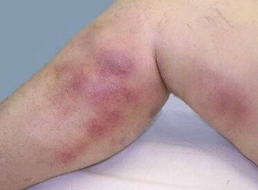 Complications of varicose veins