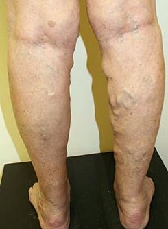 varicose veins on the legs