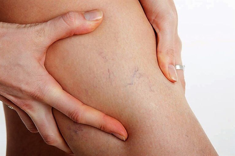 Varicose grid on the leg