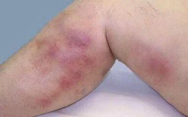 how varicose veins is manifested