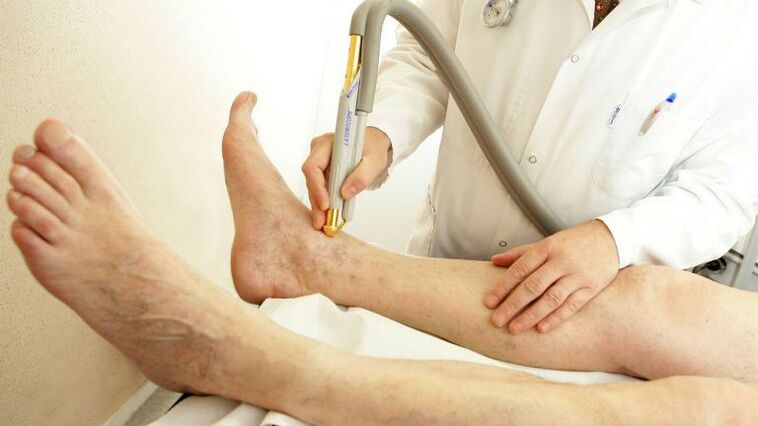 varicose veins of the internal legs