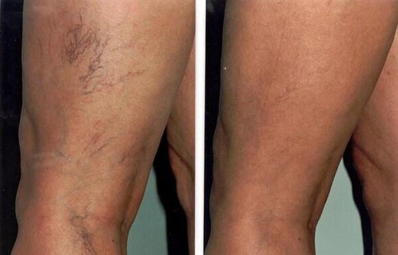 photos before and after treatment of varicose veins