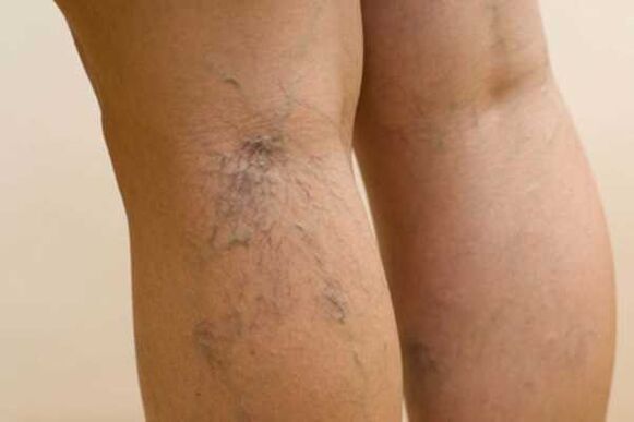 varicose veins on the leg